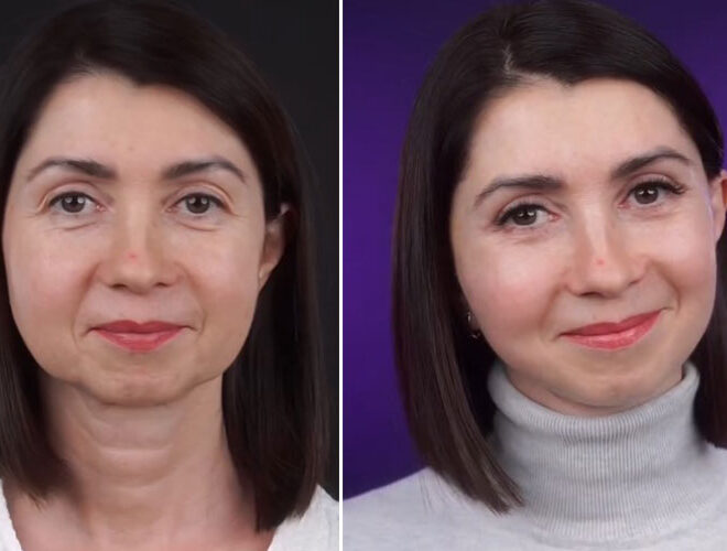 Woman, 49, Shares Her Amazing Rejuvenation Surgery Results