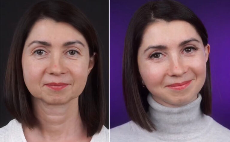Woman, 49, Shares Her Amazing Rejuvenation Surgery Results