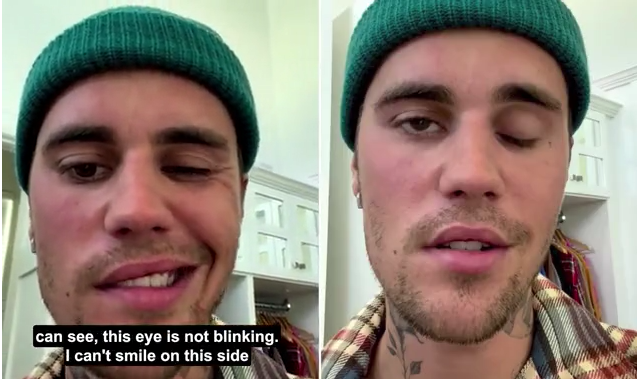 'Please pray for me': Justin Bieber reveals the right side of his face is paralysed from a rare syndrome.