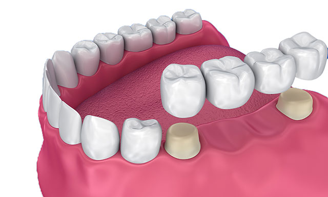 Advantages and Disadvantages of Dental Crowns