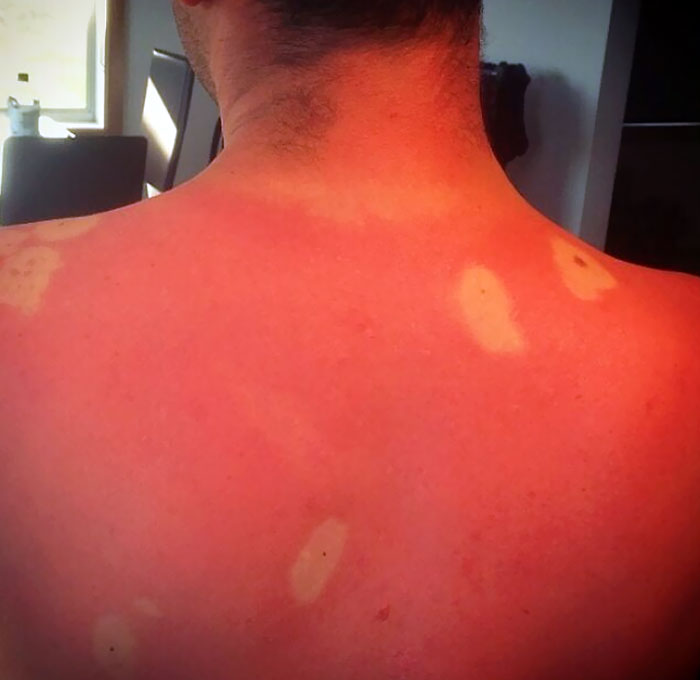 See what happened to those who thought they didn't need sunscreen. (50 ...